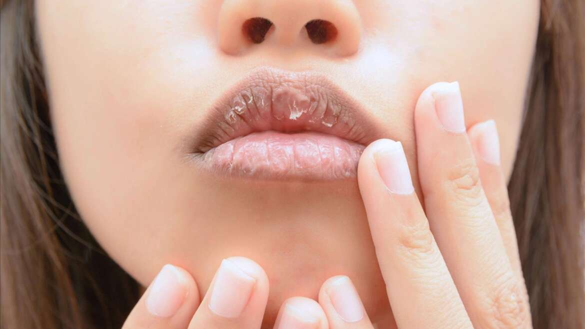 What causes dry lips, and how can you treat them? Does lip balm actually help?