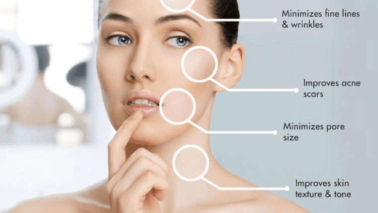 MESOTHERAPY – Best Mesotherapy Treatment in Delhi